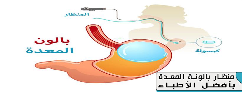 بالون المعدة